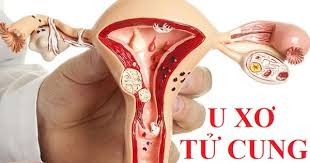 U xơ tử cung là gì? Nguyên nhân, triệu chứng