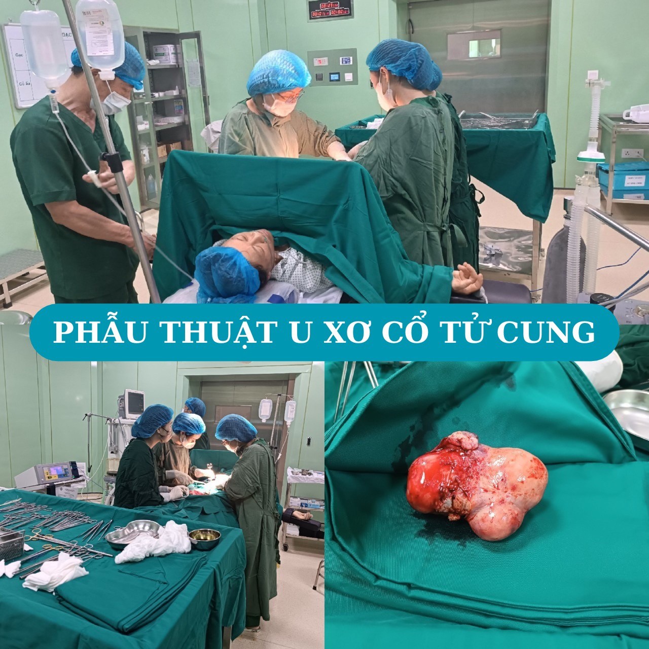 MỔ U XƠ TỬ CUNG – CẮT BÁN PHẦN TỬ CUNG TẠI BỆNH VIỆN THÁI BÌNH